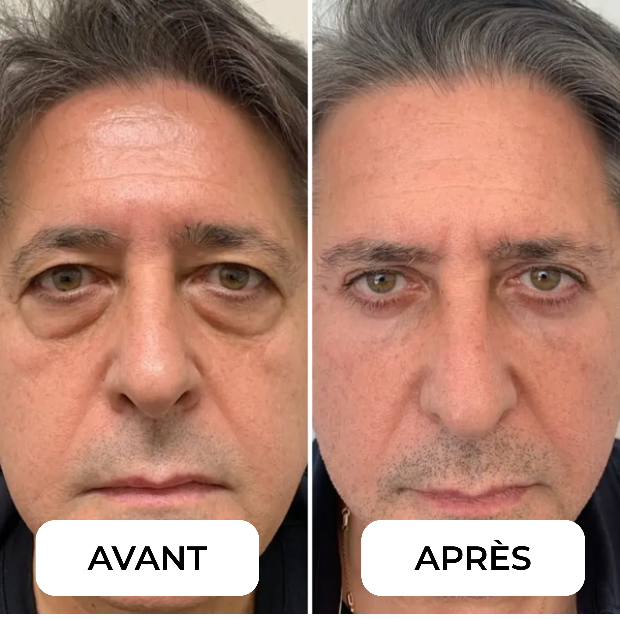 Eralia RedLight Pads™